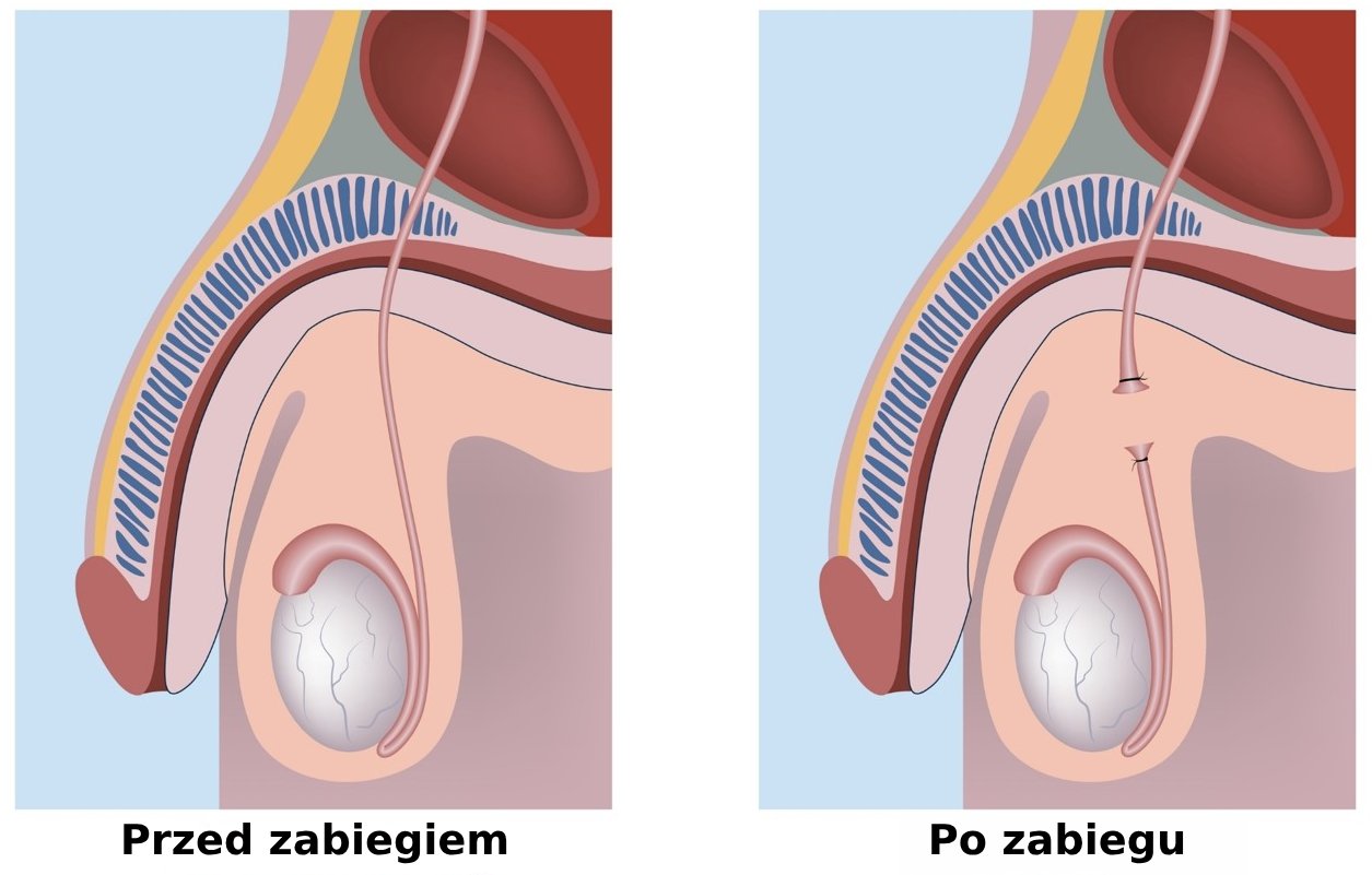 wazektomia